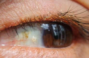 Blepharitis oder Lidrandentzündung: Symptome und Behandlung