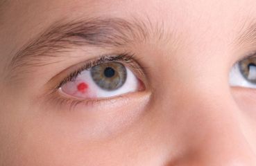 Geplatzte Ader im Auge: Ist das gefährlich und was sind die Ursachen?