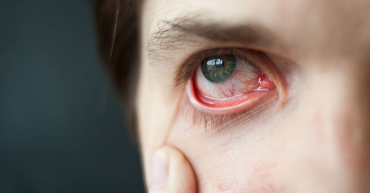 geplatzte Äderchen im Auge - Augenklinik iClinic