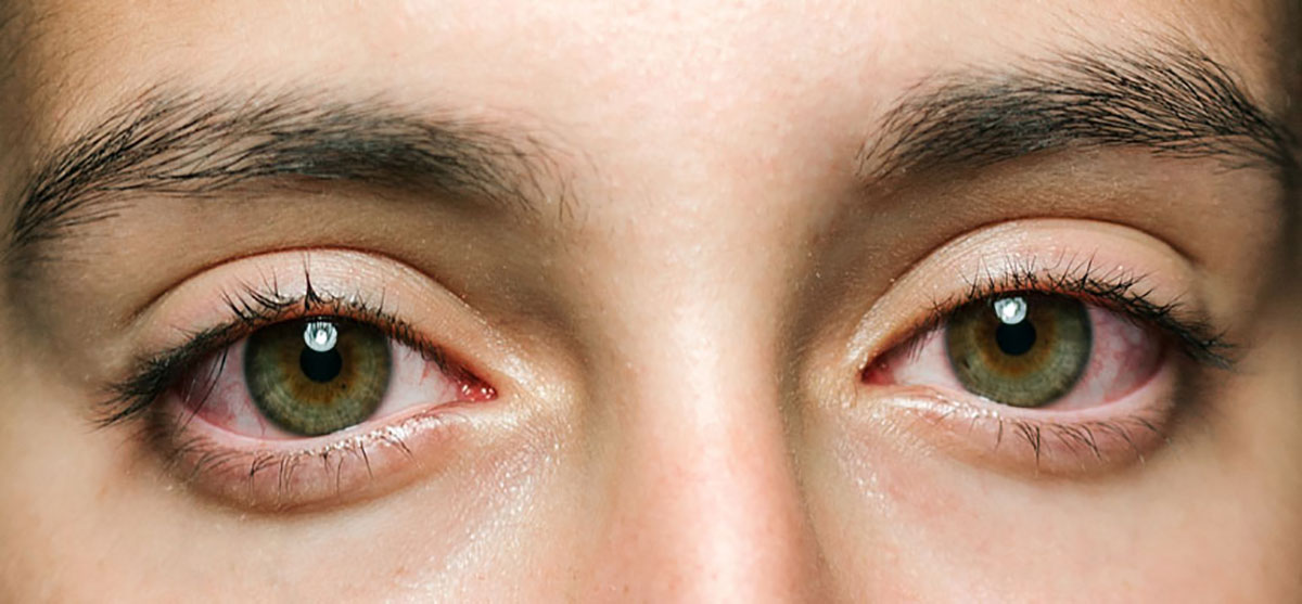Dauer einer Augengrippe