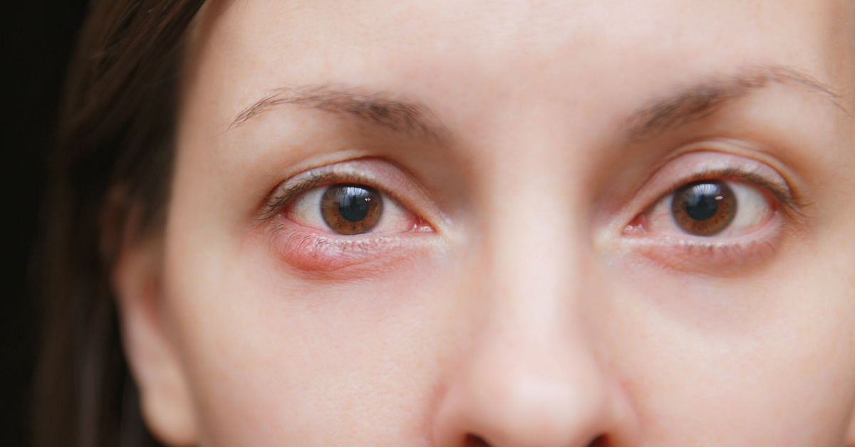 Gerstenkorn am Auge Gerstenkorn am Auge