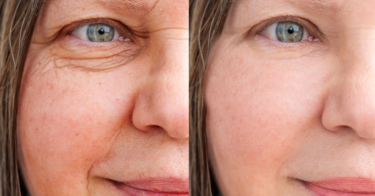 Schlupflider ohne klassisches Skalpell: Warum die Laser-Blepharoplastik eine schonendere Alternative sein kann