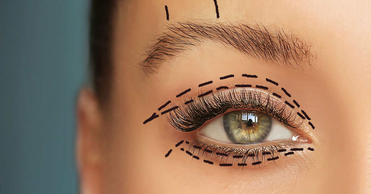 Schlupflider ohne klassisches Skalpell: Warum die Laser-Blepharoplastik eine schonendere Alternative sein kann