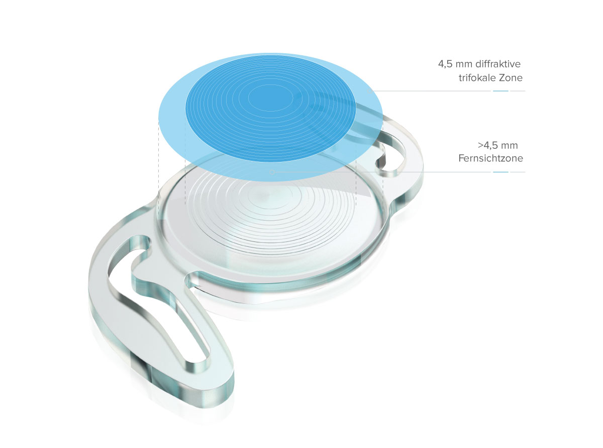 RayOne® Trifokal für Presbyopie-Korrektur RayOne® Trifokal für Presbyopie-Korrektur
