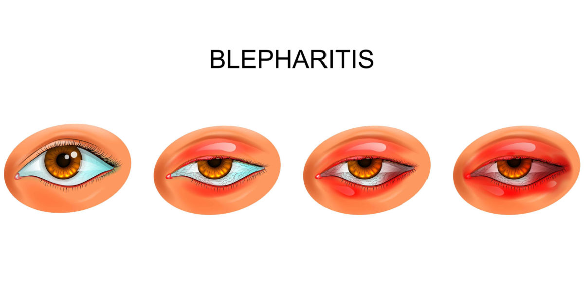 Blepharitis Lidrandentzündung Blepharitis Lidrandentzündung