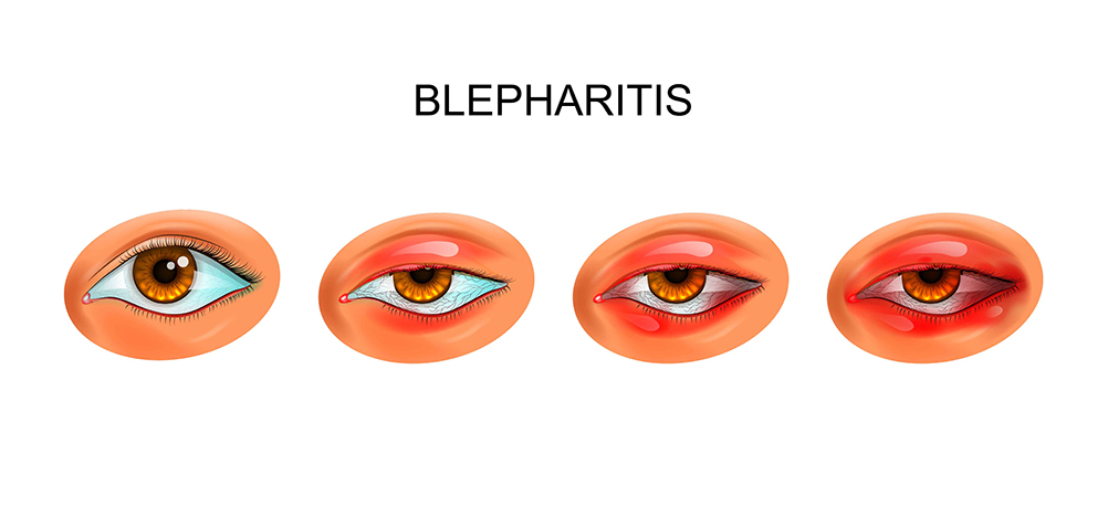 Blepharitis Lidrandentzündung
