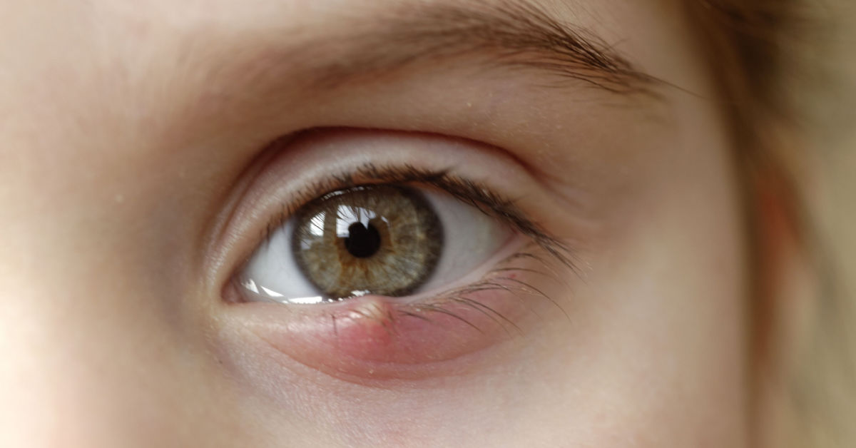 Gerstenkorn im Auge: Ursachen, Behandlung & Dauer