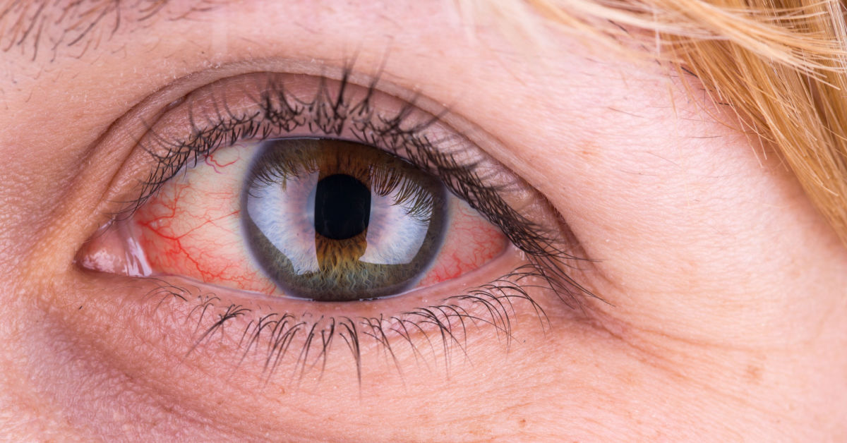 Rote Augen – ein weit verbreitetes Problem