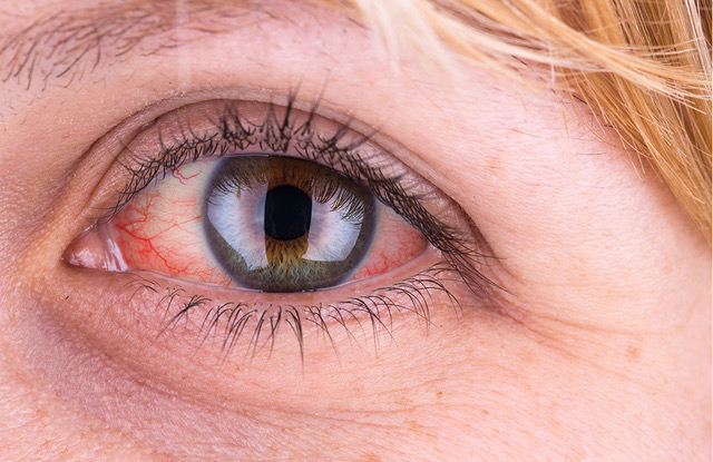 Rote Augen – ein weit verbreitetes Problem