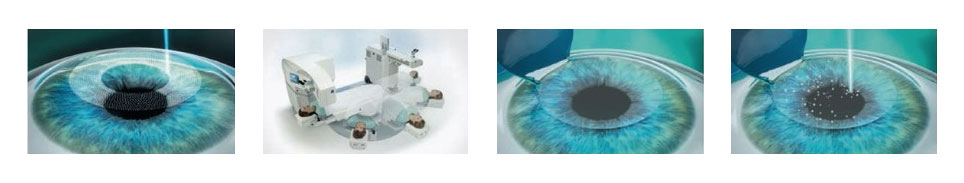 LASIK method LASIK method