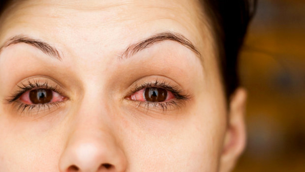 Trockene Augen: das Sicca-Syndrom